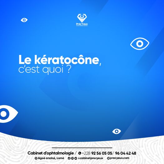 Read more about the article LE KERATOCONE